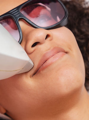 Upper Lip Laser Hair Removal